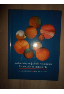 Neišnešiotų naujagimių retinopatija - Humanitas