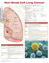 Non-Small Cell Lung Cancer Anatomical Chart - Humanitas