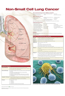 Non-Small Cell Lung Cancer Anatomical Chart - Humanitas