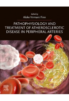 Pathophysiology and Treatment of Atherosclerotic Disease in Peripheral Arteries - Humanitas